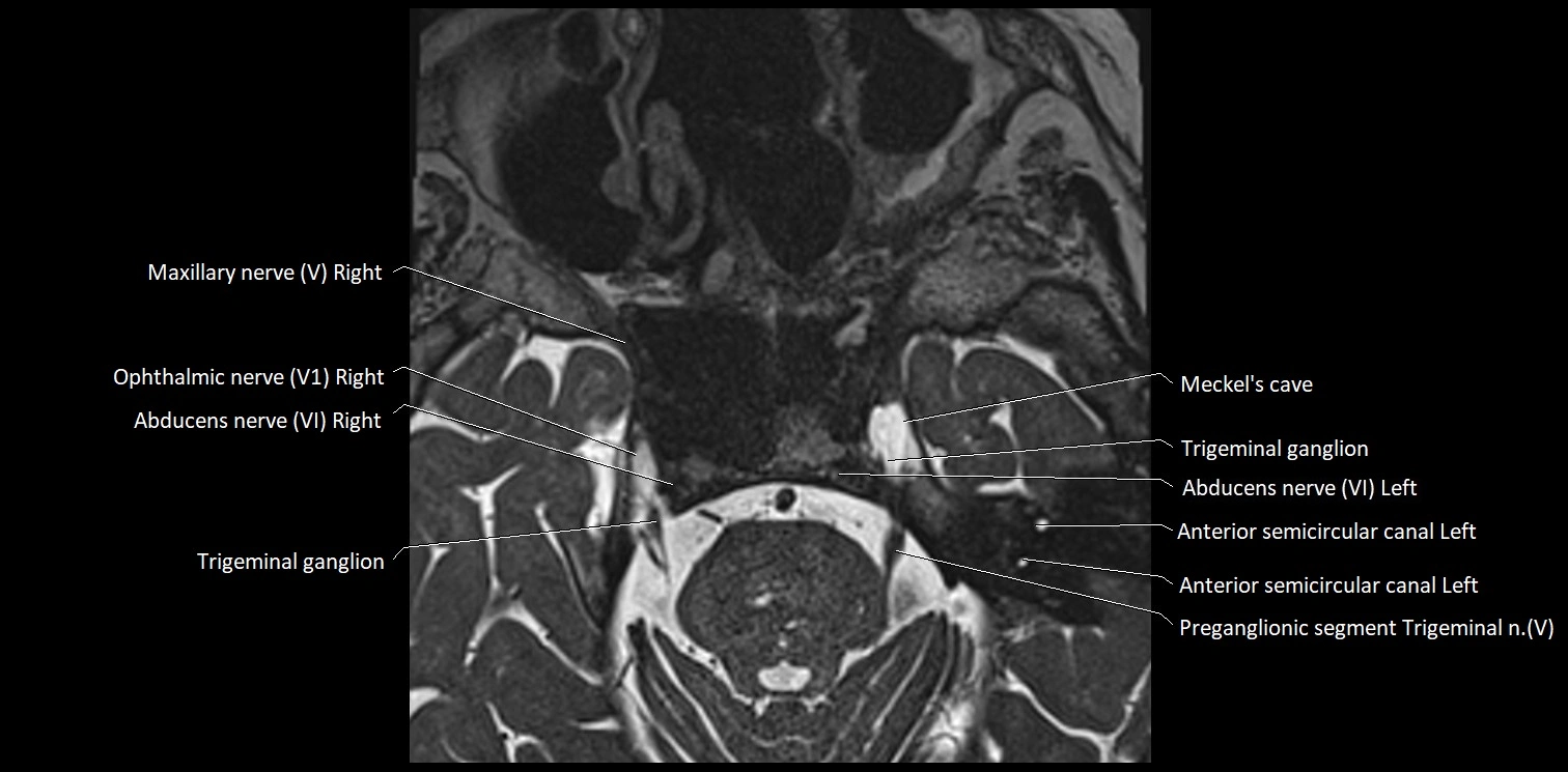 Cranial nerve anatomy axial MRI 3T image 41.webp